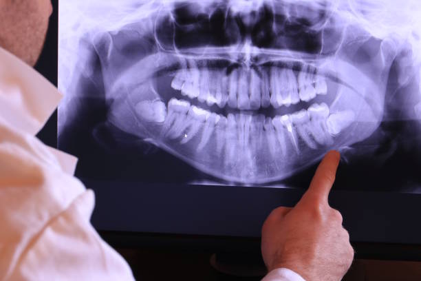 Teeth Whitening in CA