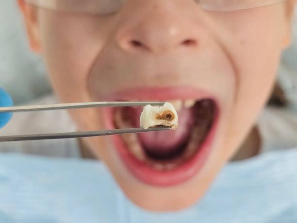 Best Chipped Tooth Repair Near Me  in Newark, CA